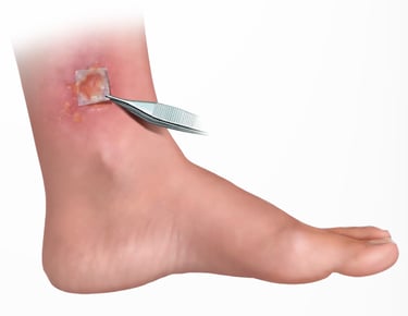 Restorigin amniotic membrane on a venous leg ulcer