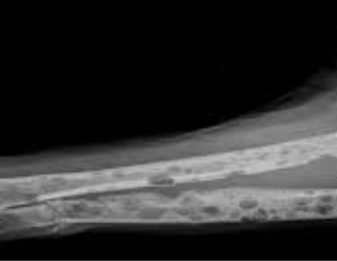 a broken bone bone bone fracture