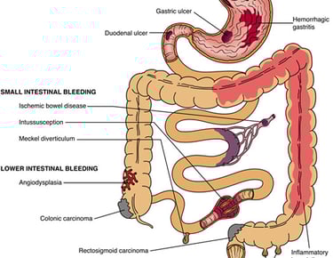 Gastrointestinal (GI) bleeding GASTRO FOUNDATION