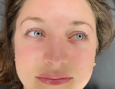 microneedling montreal