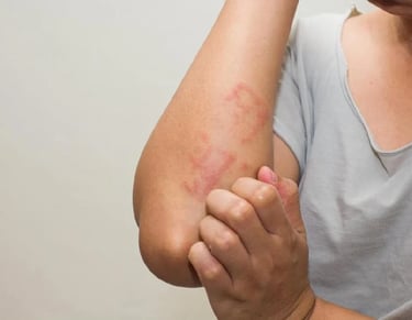 A person scratching a red, inflamed itchy skin rash on their arm, illustrating symptoms of eczema or dermatitis.