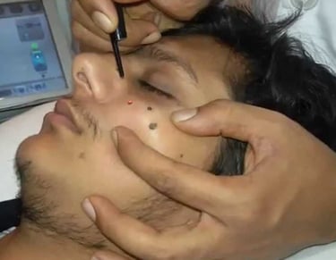 Dr. Shreya Patel, top skin specialist in Vadodara, removing viral wart of man, mole, skintag, viral wart removal