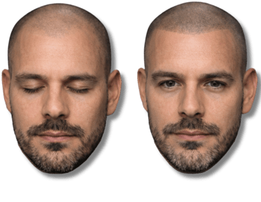 Before and after scalp micropigmentation treatment for male pattern baldness showing a restored hairline.