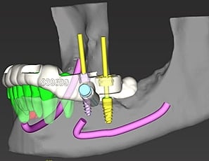 CBCT virtual planning