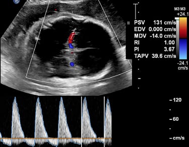 Fetal ultrasound image showing color and spectral Doppler in the brain.