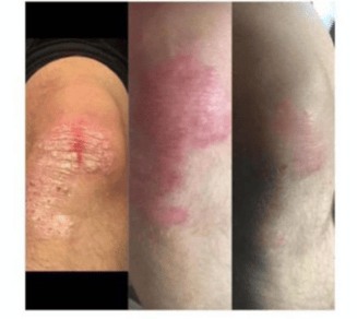 a woman's legs and legs with a red spot on her knee