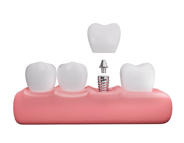 implantes dentales en las palmas de gran canaria visita gratuita