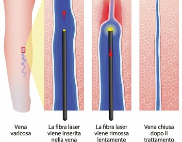 laser safena varici