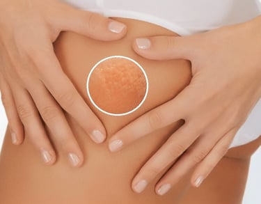 mesoterapia per cellulite e pelle a buccia d'arancia