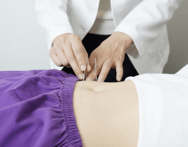 Professional acupuncturist inserting sterile acupuncture needles into a patient's abdomen for wellness treatment.