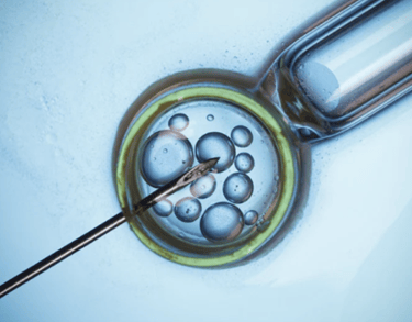 A close-up view of an intracytoplasmic sperm injection procedure under a microscope in a fertility clinic lab.