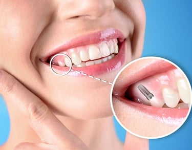 permanent tooth replacement in baner