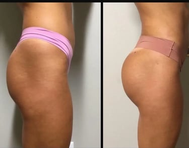 BBL before after photos in Antalya, Türkiye