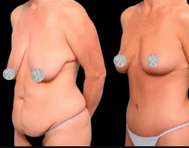 mommy makeover before after photos in Antalya Turkey