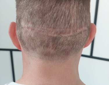 un homme avec une cicatrice sur le cuir chevelu