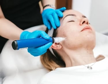Microneedling treatment for acne and skin rejuvenation performed by a doctor