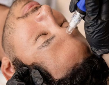 microneedling facial treatment for a man, targeting acne scars and improving skin texture