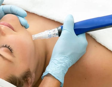 Microneedling treatment to stimulate collagen production and improve skin tone