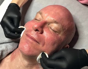 Face after microneedling treatment, showing temporary redness