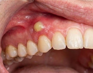 Abcès dentaire : gonflement jaune sur la gencive supérieure près d'une dent.