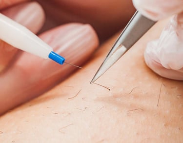 Electrolysis permanent hair removal for facial and hormonal hair in Beirut