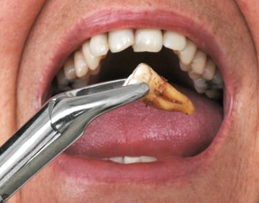 زراعة الأسنان - عيادة طب الاسنان دكتور وسام علي العباسي