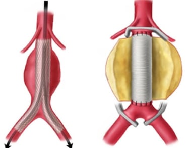 trattamento chirurgico e endovascolare aorta