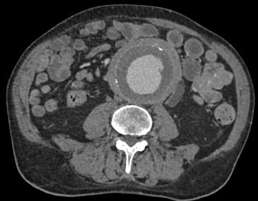 diagnosi doppler aorta e vasi addominali