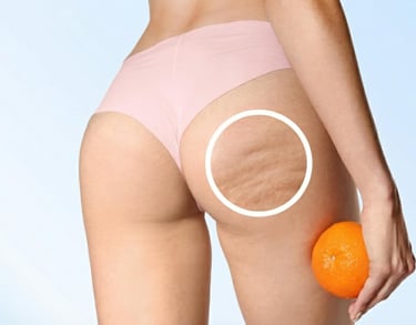 mesoterapia cellulite buccia d'arancia