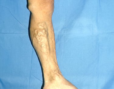 varici diagnosi e trattamento