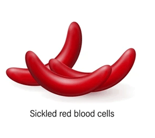 Sickle Cell Disease Association of EscaRosa: image of Sickled red blood cells