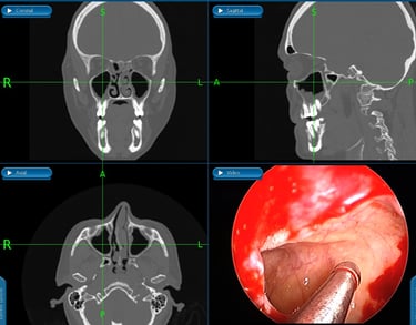 septoplastia e cirurgia endoscopica nasal em  curitiba