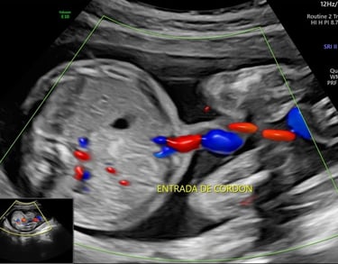 Ultrasonido tercer trimestre, flujometría, ultrasonido doppler