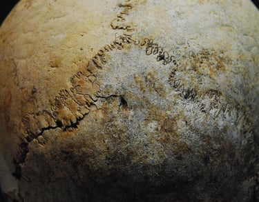 Wormian bones in the lambdoid suture