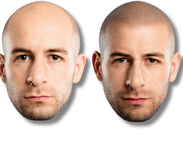 Before and after scalp micropigmentation results showing a realistic hair tattoo for male pattern baldness.