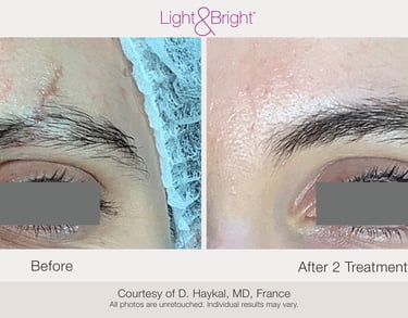 before and after scar and stretch mark treatment results in Hamilton clinic