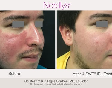 improved skin clarity after rosacea and redness treatment in Hamilton clinic