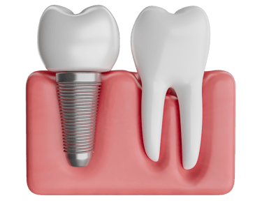 implantes dentales en las palmas