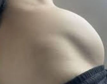 Abdominal Distension fasting
