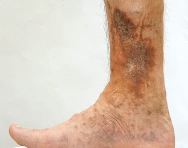 non healing ulcers in diabetes