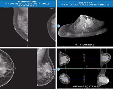 Comparison of mammography and breast CT images for dense breast tissue