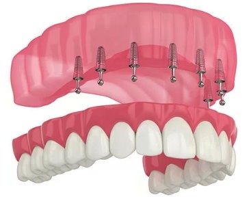 Mini Implants and Snap on Denture