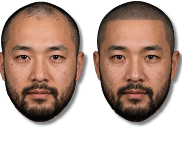Before and after scalp micropigmentation for men showing a natural looking hairline restoration.