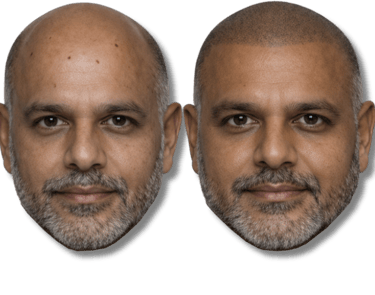 Before and after scalp micropigmentation SMP results on a man with a bald head and beard.