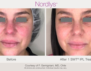 advanced skincare treatment for facial redness and sensitive skin in Hamilton Ontario