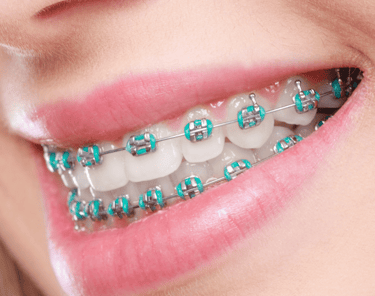 braces solution in baner