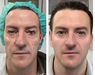 full face medicina estetica prima dopo nina gaidau rovereto trento verona bolzano