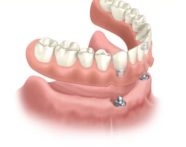 Sobredentadura inferior dos implantes