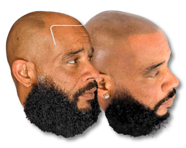 Before and after scalp micropigmentation results for a man with a beard to restore a natural hairline.