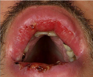 ვულგალური პემფიგუსი - სამედიცინო დოკუმენტების თარგმნა